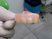 Kids Dentures - 4-1