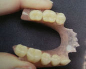 denture - removable 4